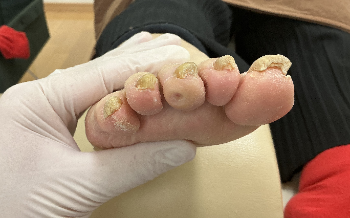 魚の目を除去した写真